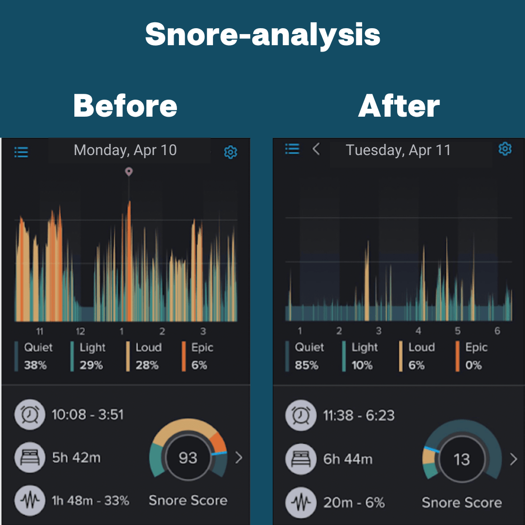 Bundle - Mouth Tape & Nose Strips - Zippit